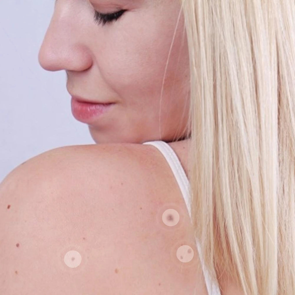 Skin Tag Removal Kit: All Natural & Hypoallergenic